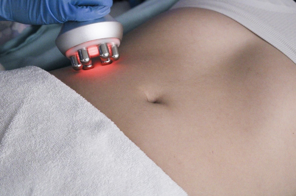 Radiofrequenza - Jessica Beauty Experiences Netanya